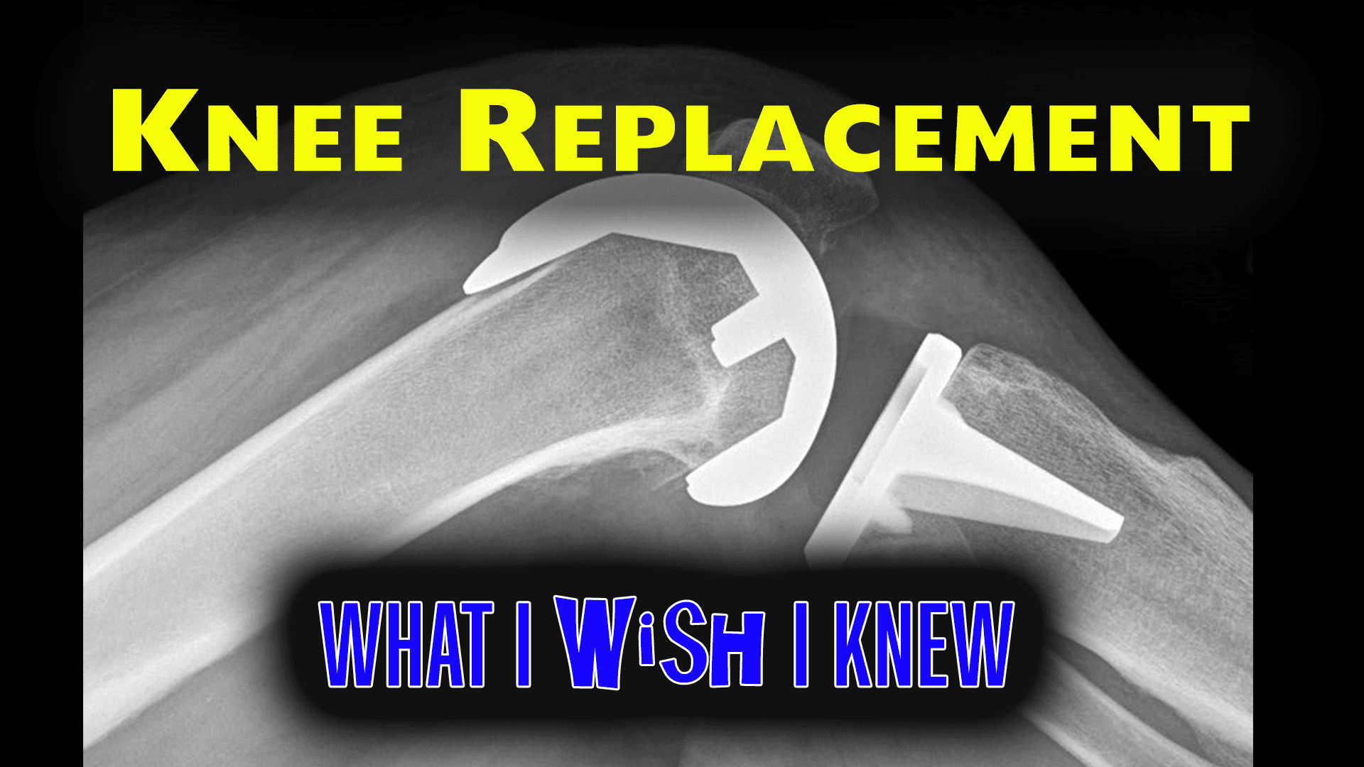 knee X-ray with text overlay, knee replacement: what I wish I knew